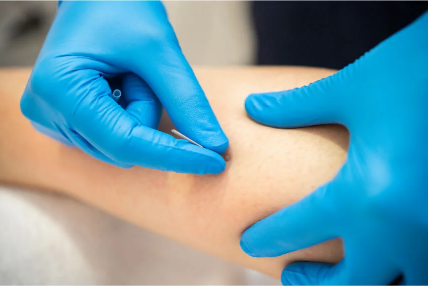Physiotherapie Solothurn - alSa Rehab - dry needling