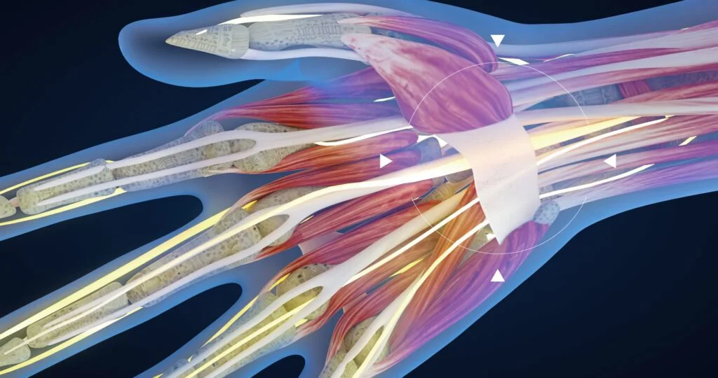Carpal tunnel syndrome, carpal tunnel syndrome, median nerve entrapment and inflammation, hand anatomy, neurons, body tissues,
