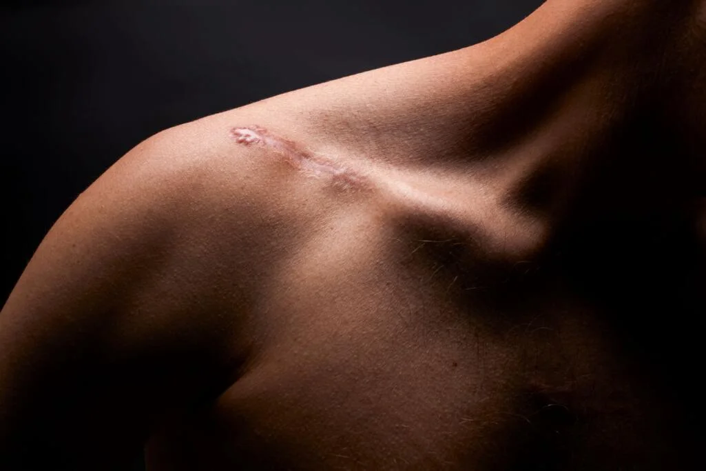 Rehabilitation Physiotherapie Schulter Operation OP