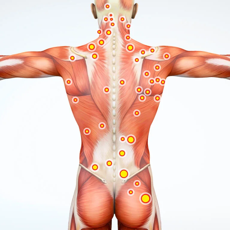 Physiotherapie Solothurn - Triggerpunkte können, wenn sie aktiv sind, Schmerzen sowohl bei Bewegungen als auch in Ruhestellung verursachen. Behandelt in alSa Rehab Physio Praxis in Solothurn