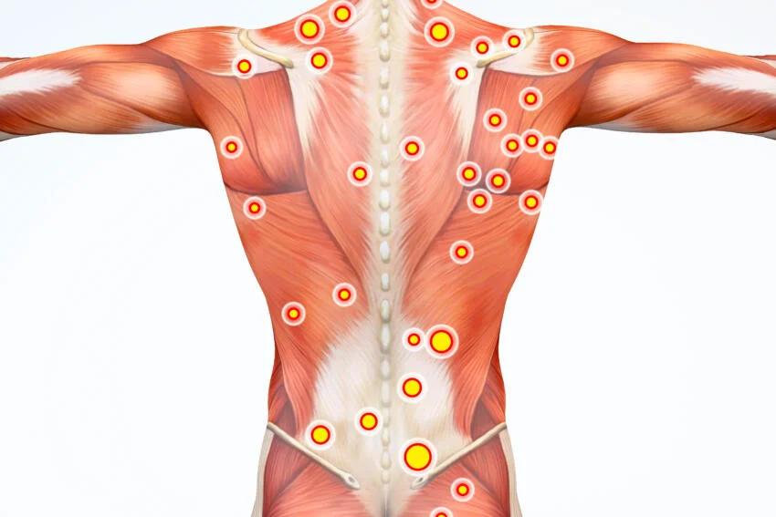 Physiotherapie Solothurn - Triggerpunkte können, wenn sie aktiv sind, Schmerzen sowohl bei Bewegungen als auch in Ruhestellung verursachen. Behandelt in alSa Rehab Physio Praxis in Solothurn