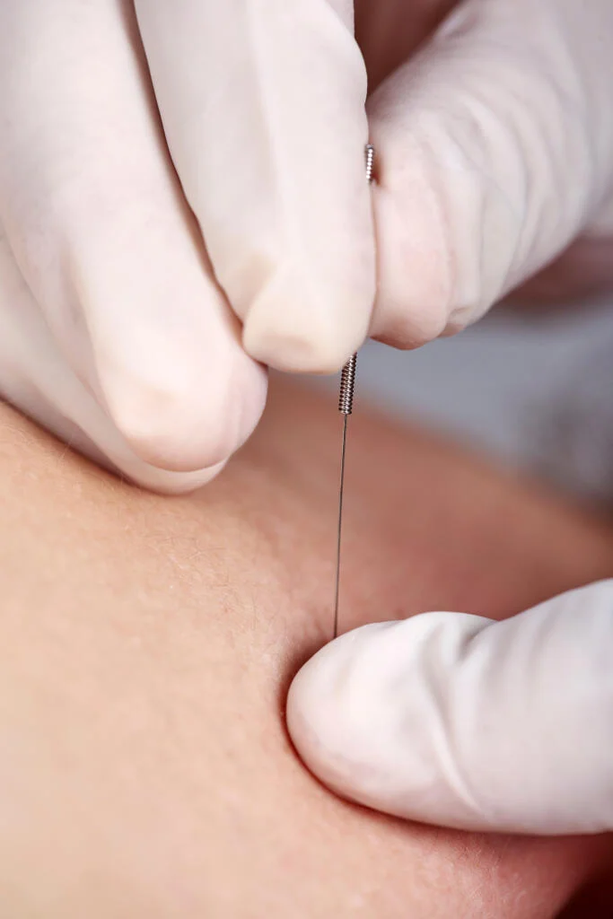 Dry-needling als Mittel gegen Rückenschmerzen