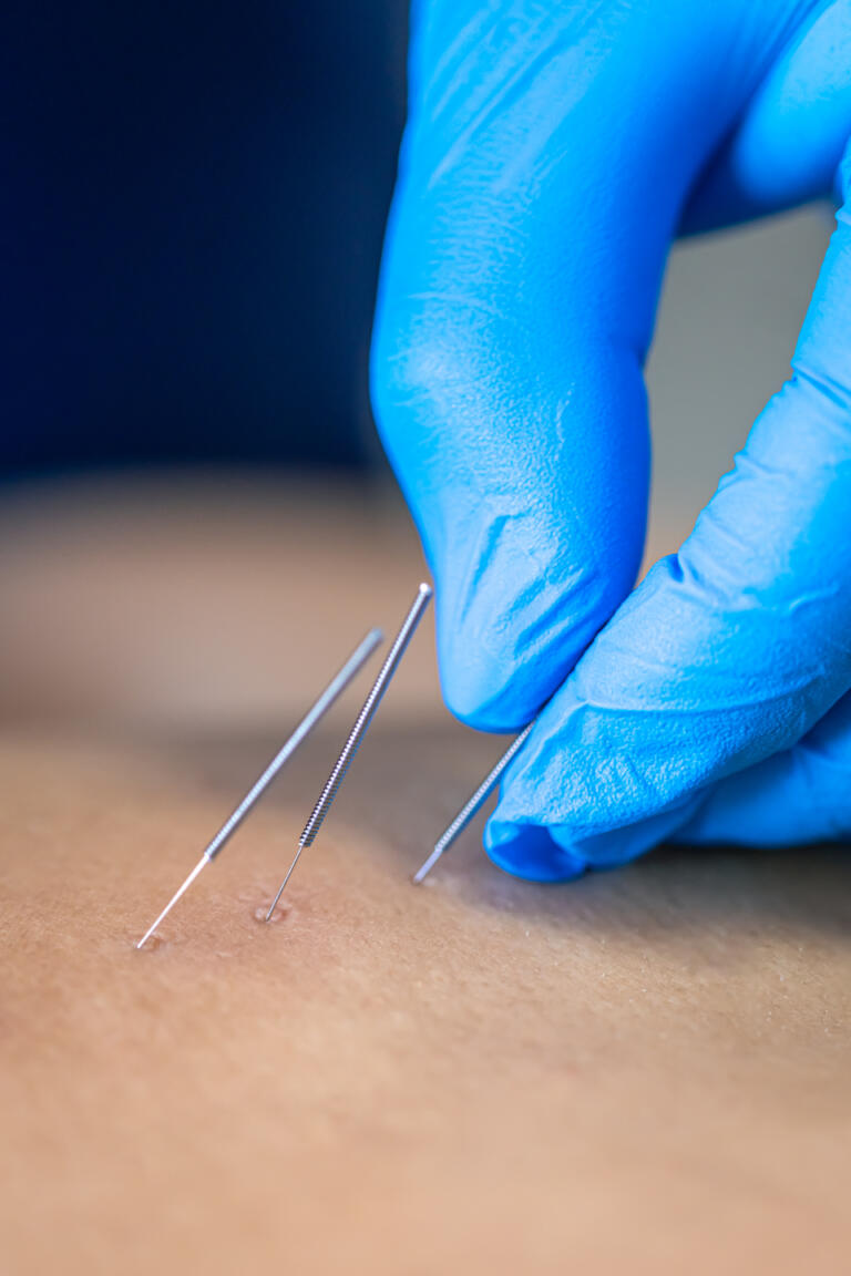 Zertifizierte Dry Needling Therapeut Stanislava Katrinakova