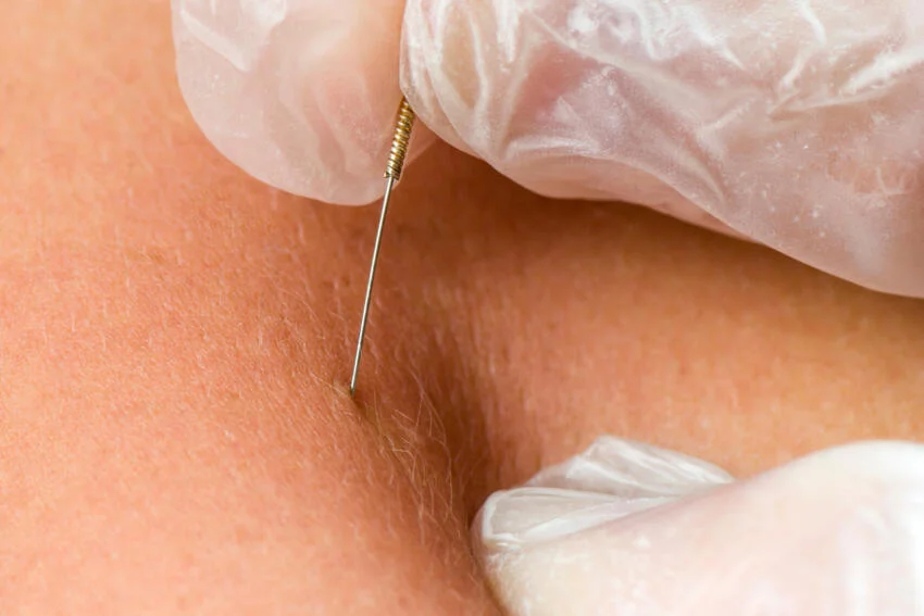 Dry needling therapie in alSa rehab