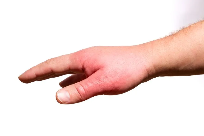 was sind schwellungen ? Antworten bei alsa rehab in solothurn Physiotherapie